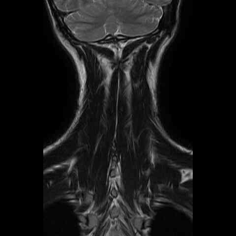 Grayscale MRI scan of my upper body with parts of my brain and cervical spine visible